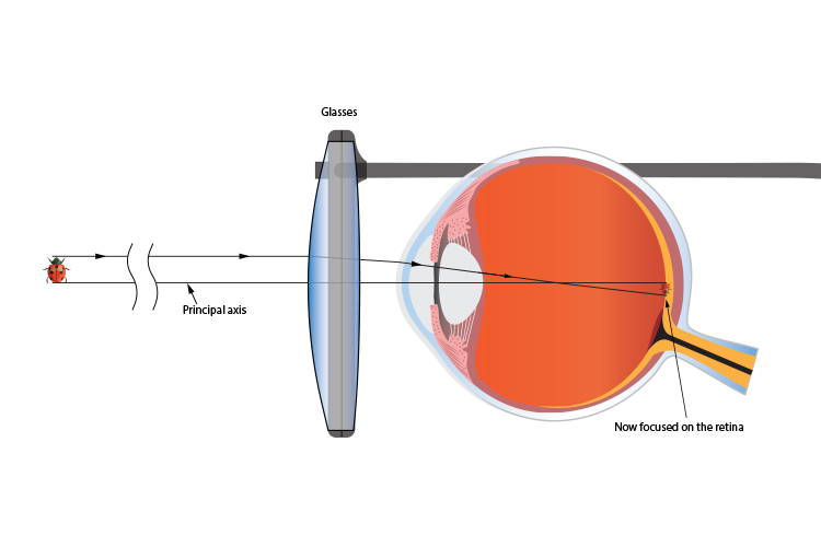 Convex lens used in glasses to correct longsightedness